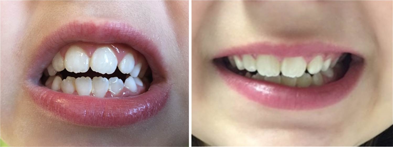 Orofacial Myofunctional Disorders can be treated at Red Door Pediatric Therapy. Child showing before and after, positive results from OMD therapy.